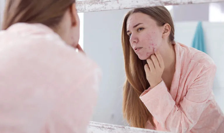 Tratamento para Acne